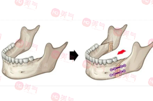 上海九院正頜手術(shù)費用揭秘，快速了解報銷標準，省錢又安心！