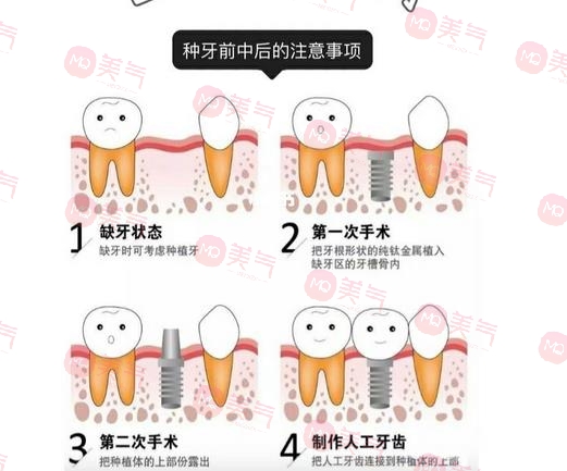 上海種植牙價格表大全更新！低至5900？內(nèi)附種植牙原理、注意事項