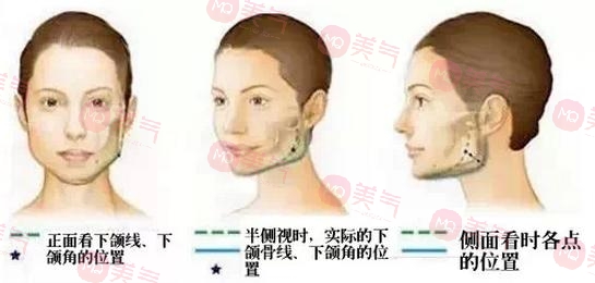 北京八大處頜面外科哪個(gè)大夫好？張智勇醫(yī)生-下頜角案例圖反饋