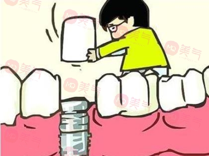 上海種植牙價格表大全更新！低至5900？內(nèi)附種植牙原理、注意事項