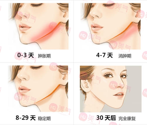 北京八大處頜面外科哪個(gè)大夫好？張智勇醫(yī)生-下頜角案例圖反饋