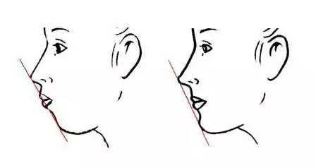 凸嘴改善介紹,效果、價(jià)格和優(yōu)缺點(diǎn)是什么？