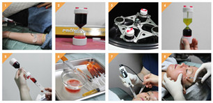 自體血清美膚真的有嗎?項目簡介_真實案例_優(yōu)缺點介紹