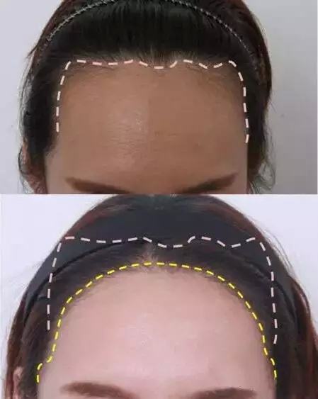 植發(fā)際線效果怎么樣？多少錢？簡介和優(yōu)缺點(diǎn)盤點(diǎn)