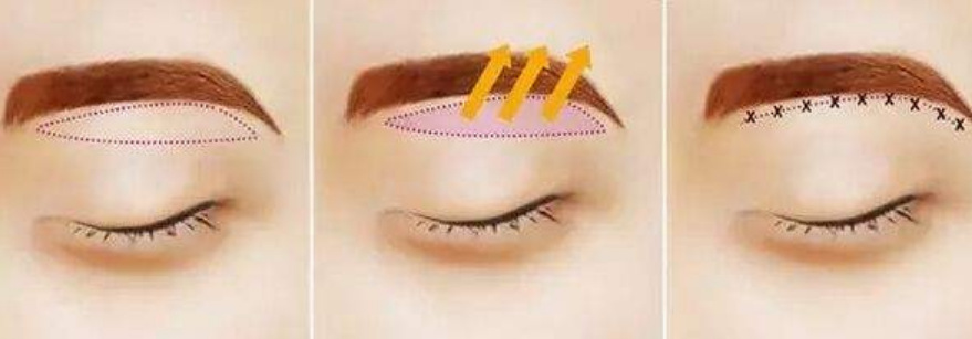 切眉術(shù)介紹,效果、價(jià)格和優(yōu)缺點(diǎn)是什么？