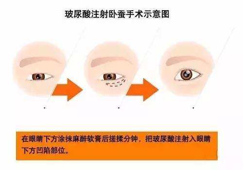 玻尿酸填臥蠶效果好不好？要多少錢？項目介紹和優(yōu)缺點盤點