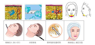 面部吸脂