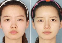 寬鼻梁矯正術(shù)真的有嗎?項目簡介_真實案例_優(yōu)缺點介紹