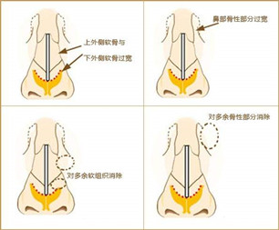 寬鼻梁矯正術(shù)真的有嗎?項目簡介_真實案例_優(yōu)缺點介紹