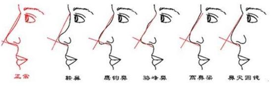 鷹鉤鼻矯正要多少錢？項目介紹和案例展示