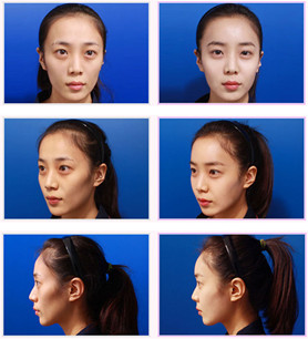 自體血清美膚真的有嗎?項目簡介_真實案例_優(yōu)缺點介紹