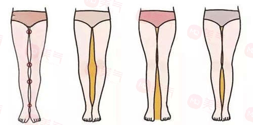 腿上抽脂究竟需要花費(fèi)多少錢？