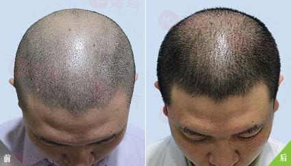 重慶毛發(fā)種植哪里有好的專業(yè)機(jī)構(gòu)嗎？