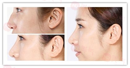 駝峰鼻治療有哪些方法？如何有效治療駝峰鼻？