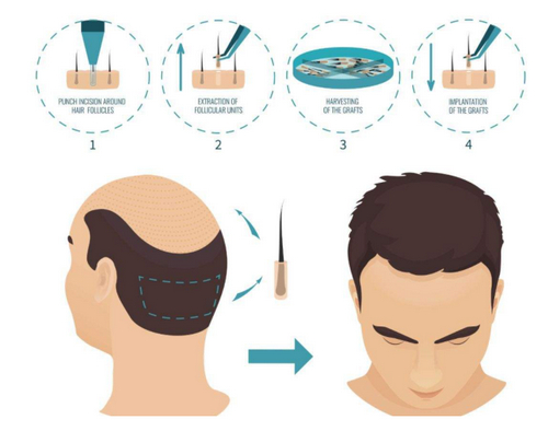 廣州倍生植發(fā)醫(yī)院技術(shù)如何？選對(duì)醫(yī)院不再為禿頭煩惱！