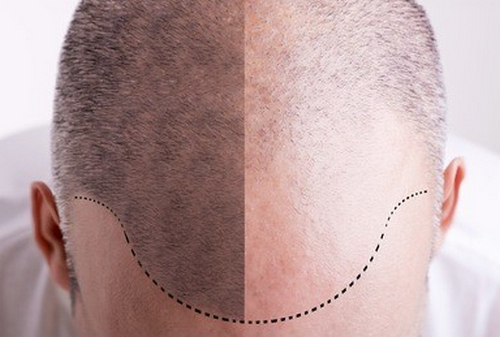 廣州首瑞植發(fā)口碑好嗎？有你青睞的發(fā)際線種植醫(yī)生嗎？