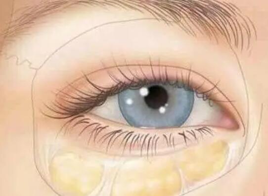 脂肪填充淚溝有哪些注意事項(xiàng)？關(guān)于脂肪填充你了解多少？