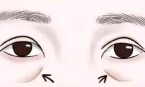 填充淚溝選擇自體脂肪還是玻尿酸好？一般可以維持多長(zhǎng)時(shí)間？