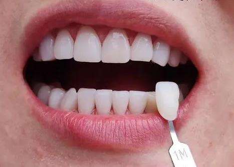 全部牙齒貼面的價(jià)格是多少？選擇材料不同相差價(jià)格較大！