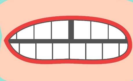 牙縫大了怎么補(bǔ)救？常見的修復(fù)方式就是貼面修復(fù)，正畸矯正，牙冠修復(fù)等