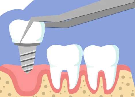 全口種牙價格是多少錢？通常情況下需要4萬元到15萬元之間