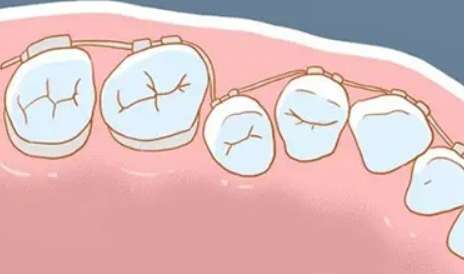 糾正牙齒需要多少錢費(fèi)用？需要1萬元到5萬元之間，具體的價(jià)格要根據(jù)當(dāng)?shù)氐南M(fèi)水平