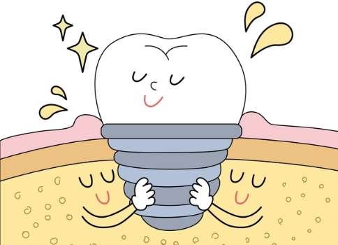 北京種牙多少錢？種植一顆的費用大概是從8000元到2萬元之間