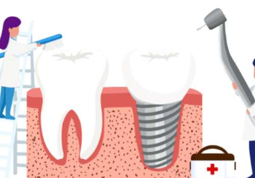 門牙種植的全部過程是什么？過程有口腔檢查、手術麻醉、種植人工牙根、等待骨結合期、牙冠修復等