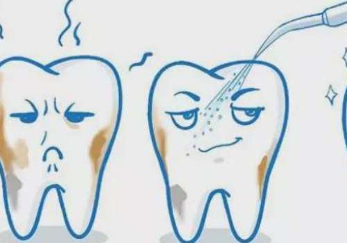 補后槽牙多少錢一顆？在200元到1000元左右，補牙的材質(zhì)不同，價格會有所差異