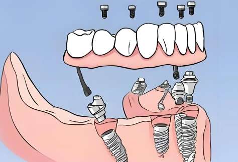 種植牙的報價公布！一顆大約是在4000元都15,000元之間