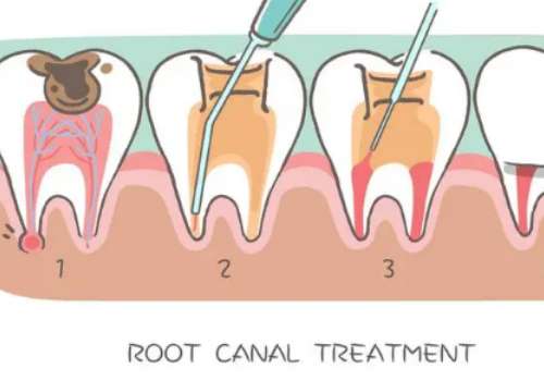 南京種牙價(jià)格一般多少錢?種一顆牙需要5000至30000元，價(jià)格只供參考