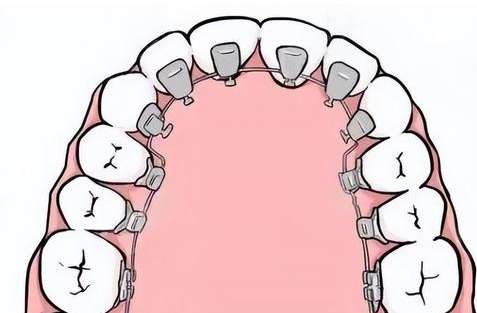 牙齒矯正大概多少錢啊？費(fèi)用是8000元到2萬元之間