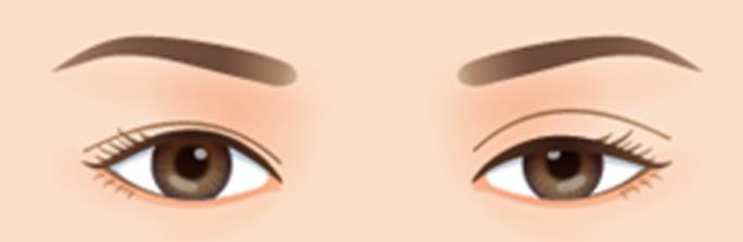 雙眼皮hg04.jpg
