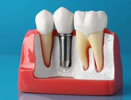 西南醫(yī)院種植牙好還是新橋醫(yī)院種植牙好？分享兩個(gè)醫(yī)院簡(jiǎn)介一覽