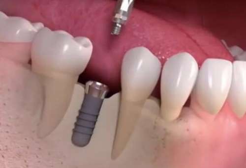 成都華西牙科種植牙多少錢？種植牙價格為6000元起