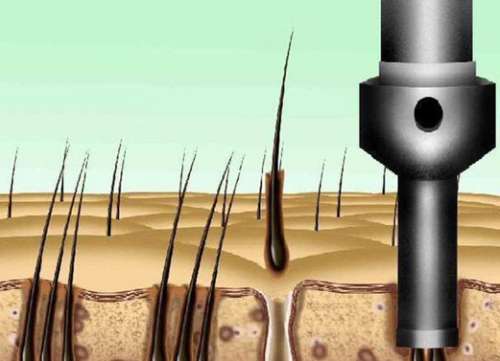 四川省人民醫(yī)院植發(fā)咋樣？熱門醫(yī)院信息預(yù)覽