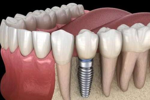浙大口腔醫(yī)院種植牙怎么樣？含醫(yī)院介紹，醫(yī)生名單了解