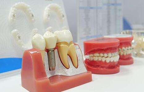 江蘇省口腔醫(yī)院種植牙多少錢？了解費(fèi)用標(biāo)準(zhǔn)，含人氣醫(yī)生介紹