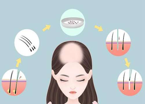 邵逸夫醫(yī)院植發(fā)價格是多少？更新價格詳情和網(wǎng)友口碑查看