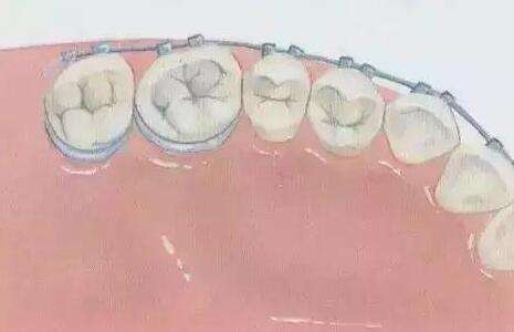 鄭大一附院牙齒矯正價格表一覽？項目費用在線分享