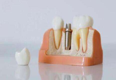 重慶醫(yī)科大學(xué)附屬第一醫(yī)院種植牙價(jià)格是多少？醫(yī)院簡介及費(fèi)用大全分享