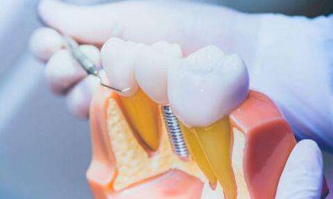 哈爾濱醫(yī)大一種植牙多少錢？分享價(jià)格標(biāo)準(zhǔn)-技術(shù)特色了解