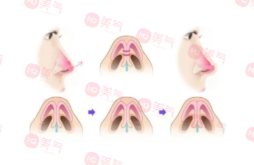 自體肋骨隆鼻的危害有哪些？手術(shù)風(fēng)險(xiǎn)、疼痛和腫脹…