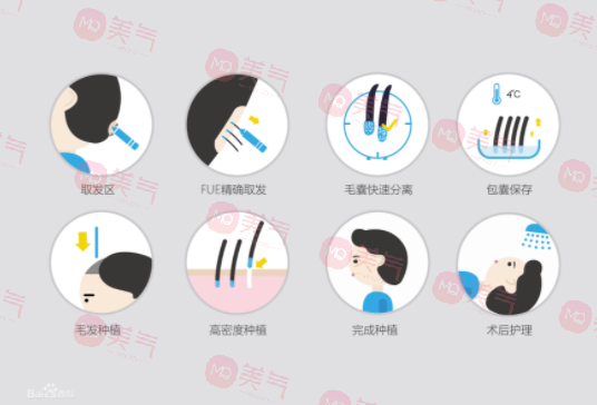 植發(fā)手術(shù)