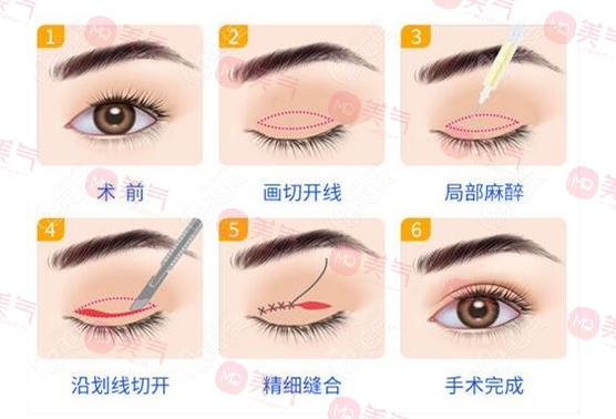 上海九院雙眼皮哪個醫(yī)生比較好？