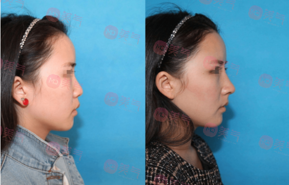 北京八大處整容醫(yī)院做鼻子多少錢？