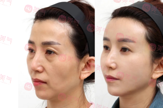 北京八大處整容醫(yī)院做拉皮多少錢？