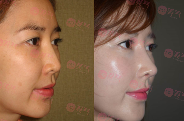 北京八大處做面部脂肪填充多少錢？