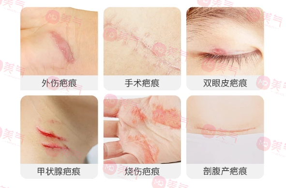 北京八大處整容醫(yī)院做疤痕修復(fù)多少錢？