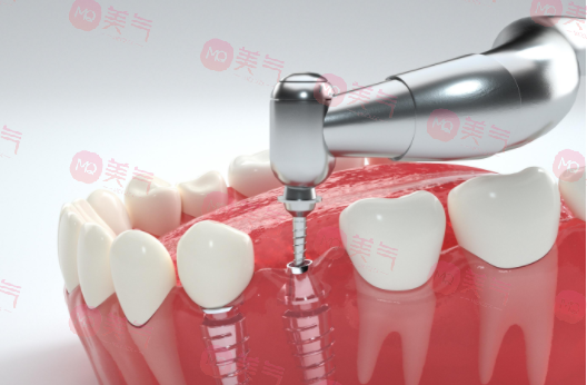 種植牙齒多少錢(qián)一顆2023?
